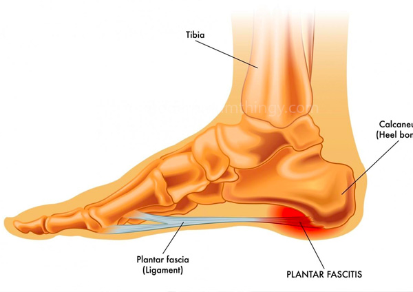 sakit tumit plantar fasciitis